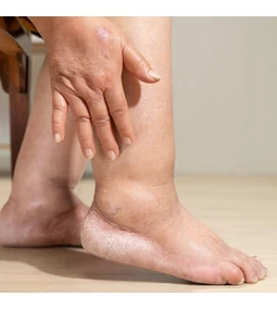 Schwellung der Beine und Entstehung von Geschwüren bei Diabetes: Die Lösung von Dr. Silver Silber Socken.